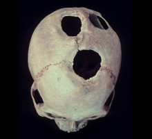 Подход с головой: древние медики успешно проводили трепанацию черепа